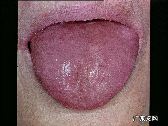 哪些人会得干燥综合症 干燥综合症的症状是什么