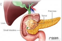 胰腺炎怎么治疗？