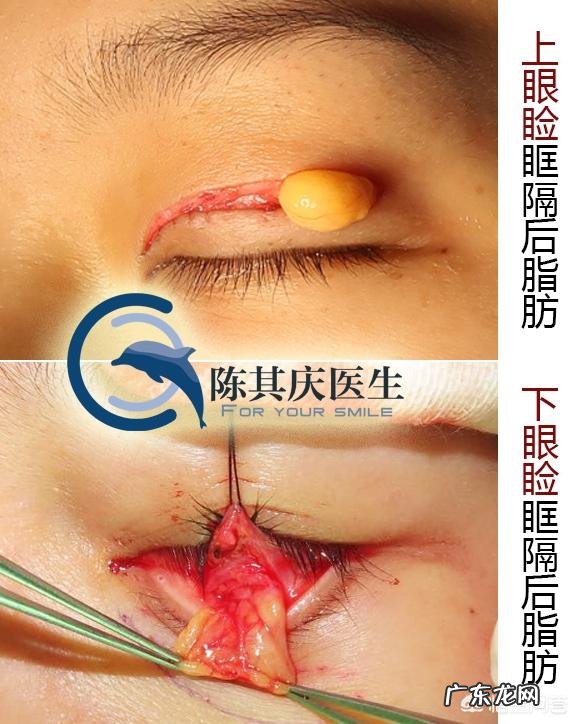 眼睑抽脂需要几天可以恢复?