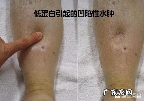 早起出现哪些症状，说明肝病加重了？