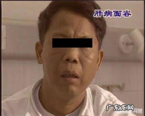 早起出现哪些症状，说明肝病加重了？