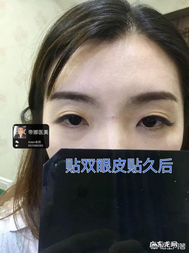 三眼皮怎么变回双眼皮?