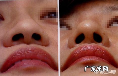鼻子大，鼻翼宽怎么办？