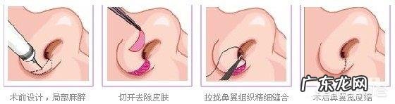 鼻子大，鼻翼宽怎么办？