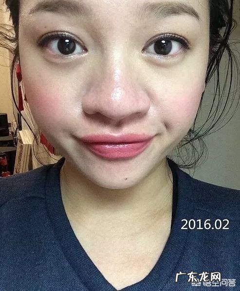 鼻子大，鼻翼宽怎么办？