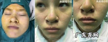 鼻子大,鼻翼宽怎么办?