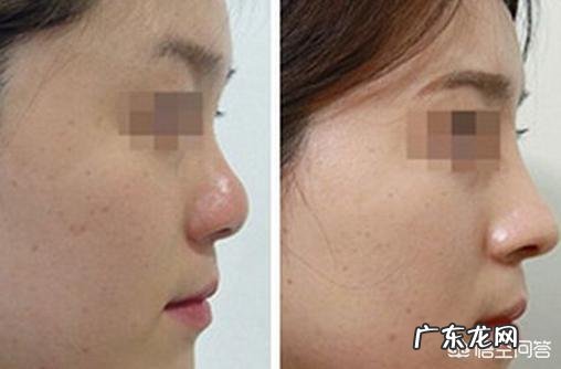 鼻子大,鼻翼宽怎么办?