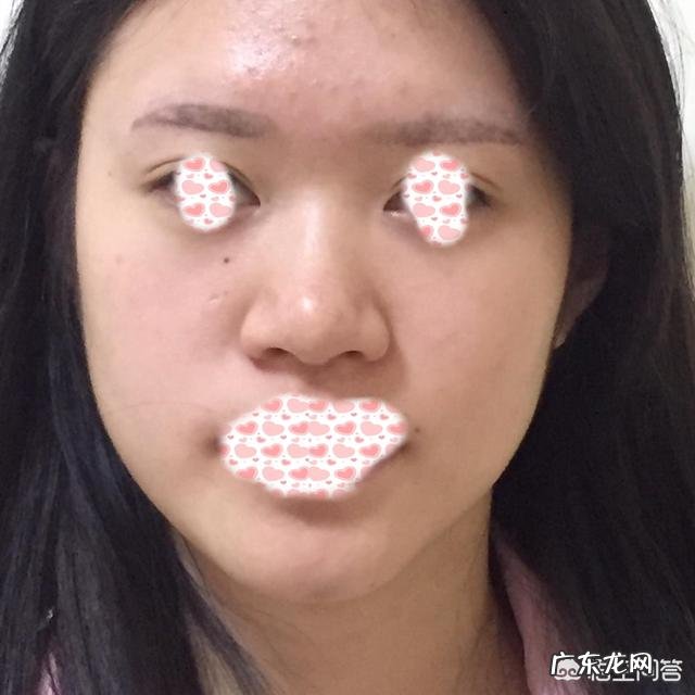 鼻子大，鼻翼宽怎么办？