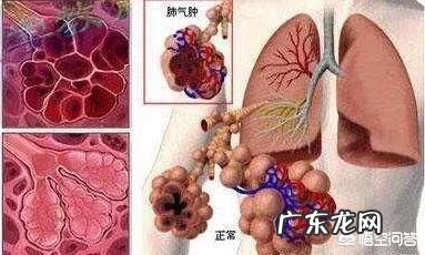 慢性支气管炎和哮喘有什么不同?