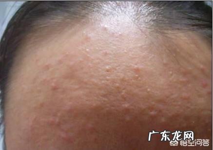 额头上不断长痘痘,还反反复复不消是怎么回事?需要怎样做才能很好的缓解呢?