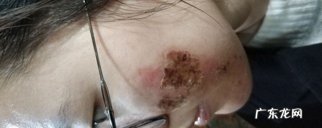 水痘坑的修复方法