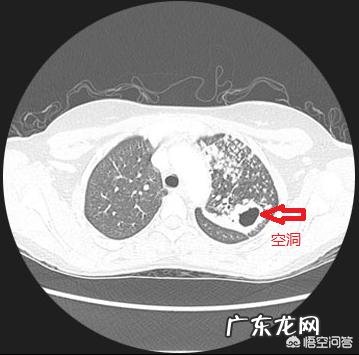肺结核钙化了是什么意思？