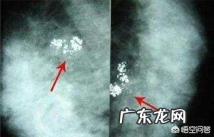 肺结核钙化了是什么意思？