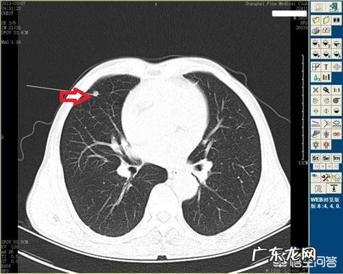 肺结核钙化了是什么意思?