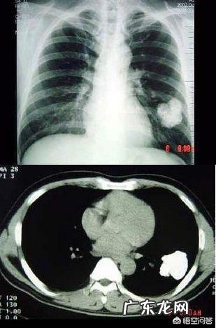 肺结核钙化了是什么意思?