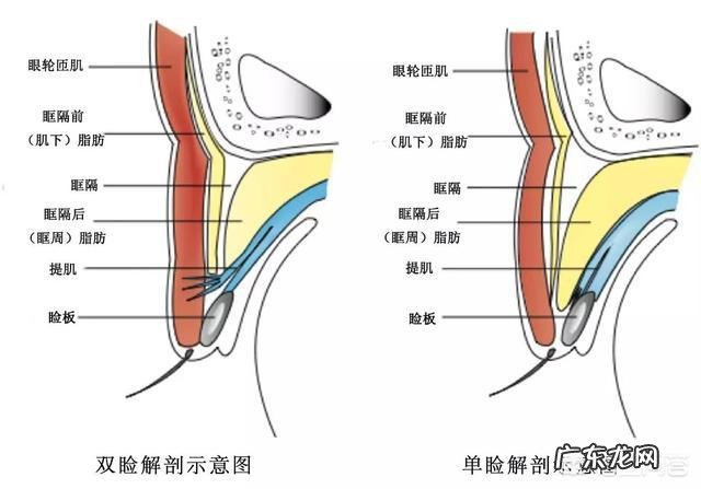 双眼皮手术方法有哪些?