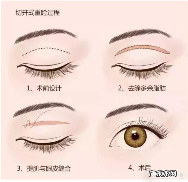 双眼皮手术方法有哪些?