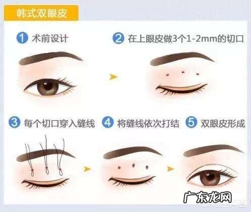 双眼皮手术方法有哪些?