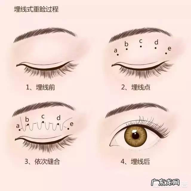 双眼皮手术方法有哪些?