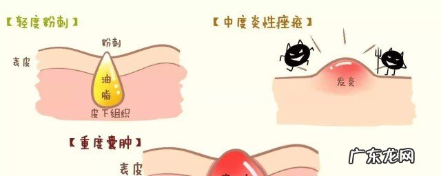 怎样处理青春痘