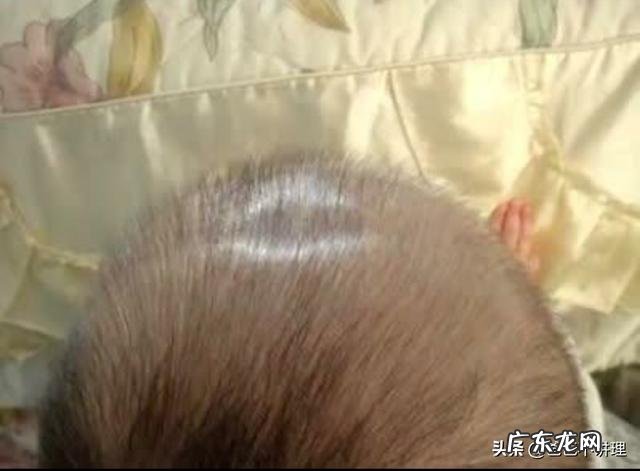 宝宝七个月前囟门就闭合,这正常吗?