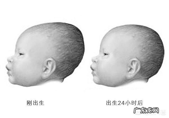 宝宝七个月前囟门就闭合,这正常吗?