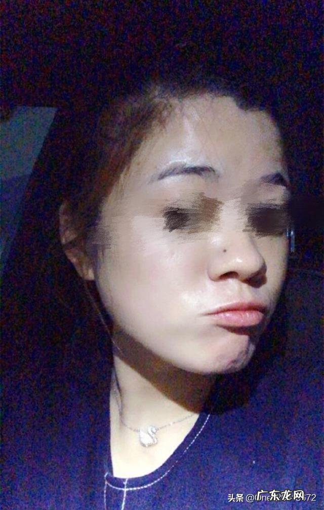 女生们有什么快速消除咬肌的方法?