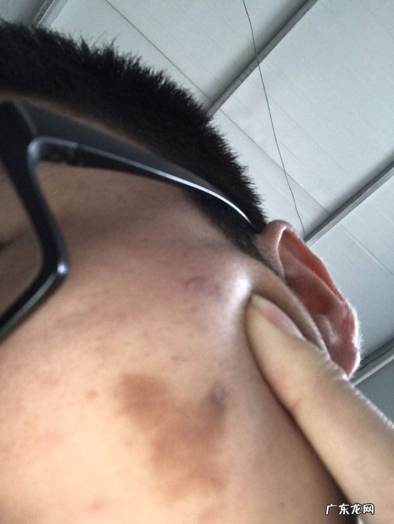 消除疤印的方法