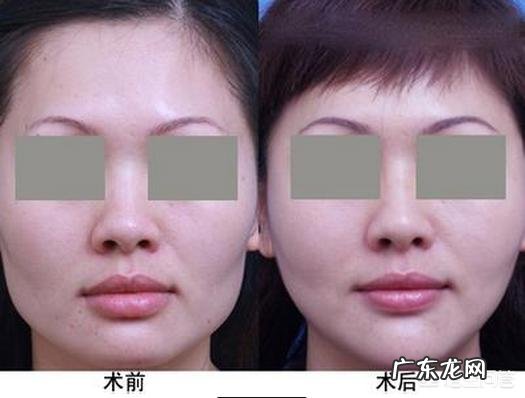 面部吸脂减肥多少钱？