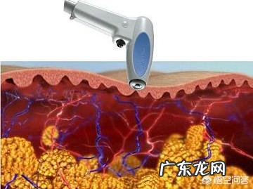 射频美容仪可以祛皱吗?