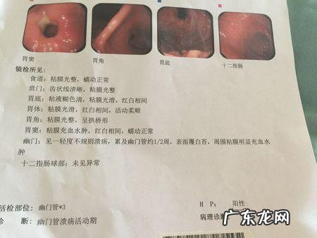 胃镜化验单阴性与阳性分别是什么?