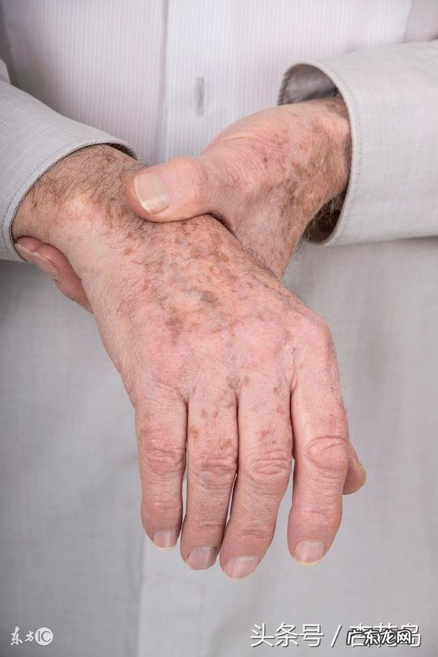 老年斑是怎么回事？