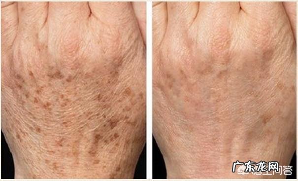 老年斑是怎么回事?