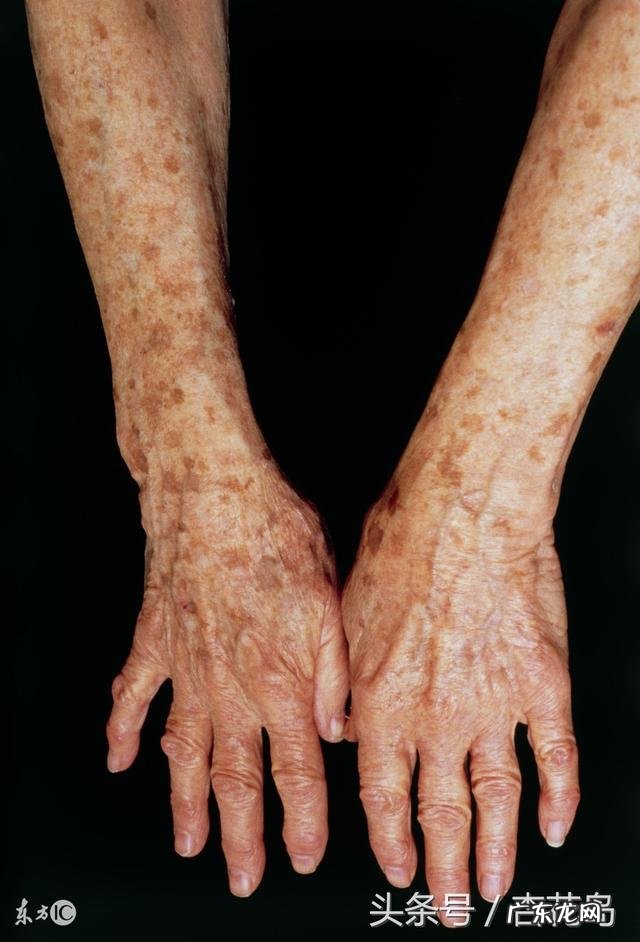 老年斑是怎么回事？