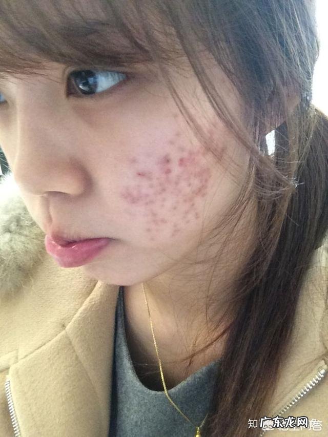 如何有效祛痘且不留痘印?