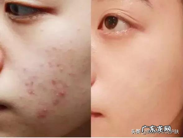 如何有效祛痘且不留痘印?