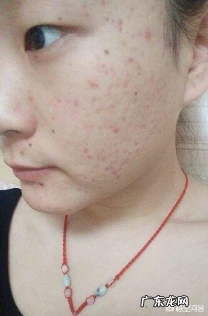 如何有效祛痘且不留痘印?