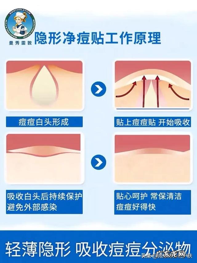 如何有效祛痘且不留痘印?