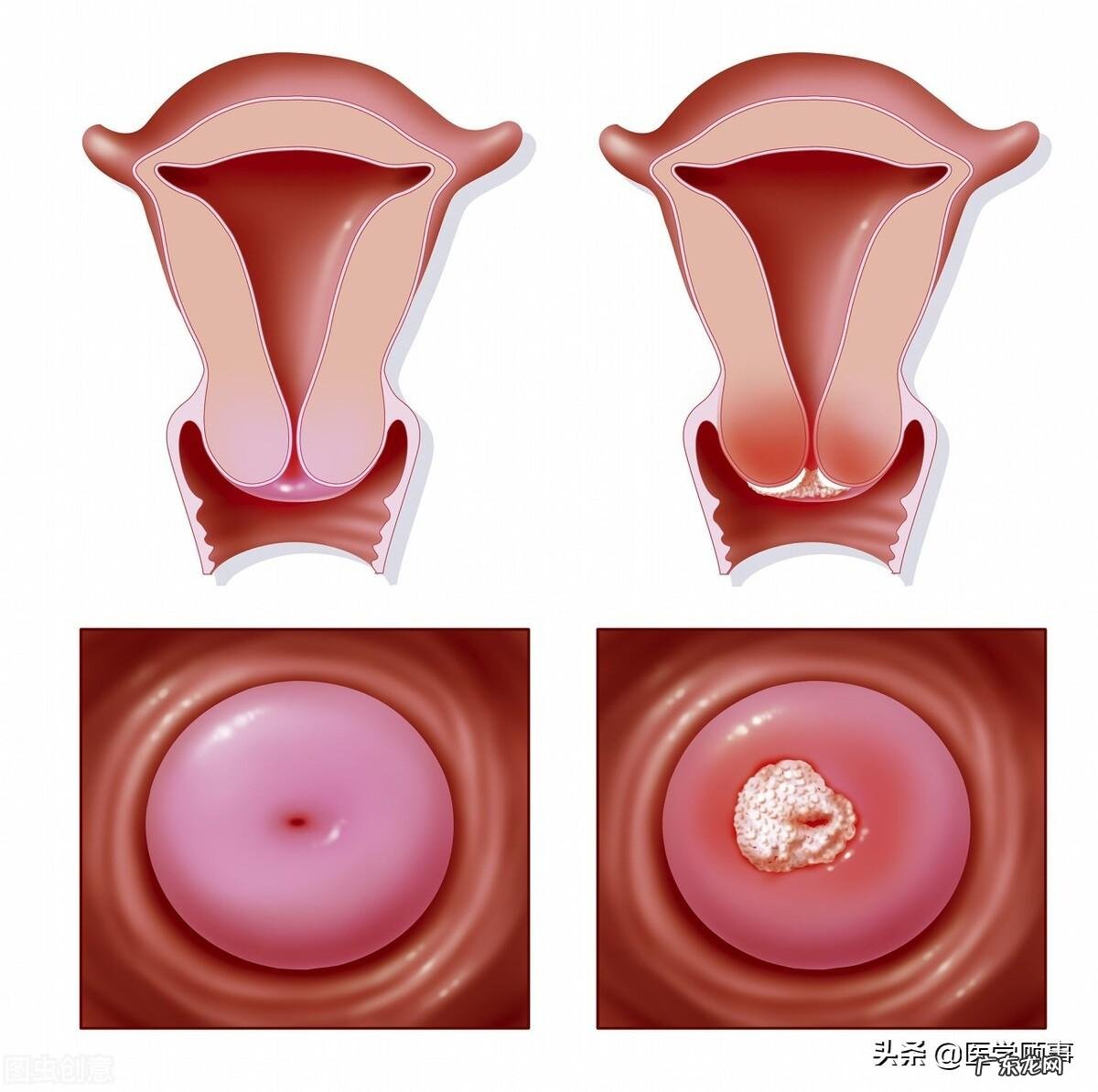 hpv疫苗有没有必要打 宫颈癌疫苗有必要打吗?