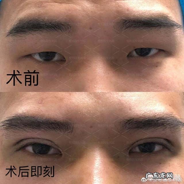 对于男生割双眼皮你们怎么看?
