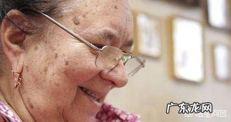 黄褐斑、雀斑、老年斑主要有哪些表现?如何区分?