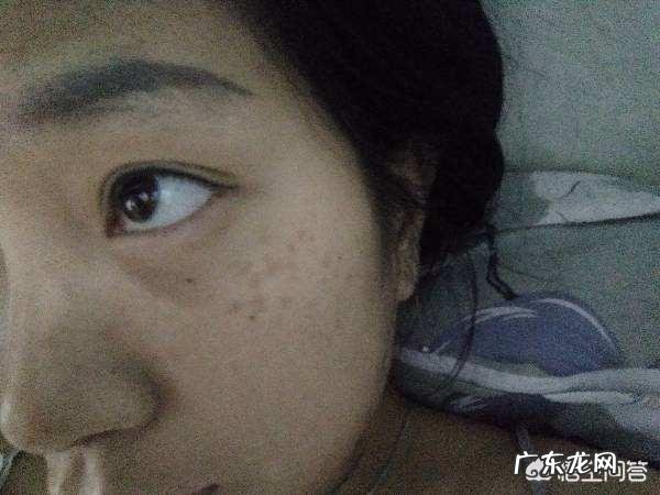 黄褐斑、雀斑、老年斑主要有哪些表现?如何区分?