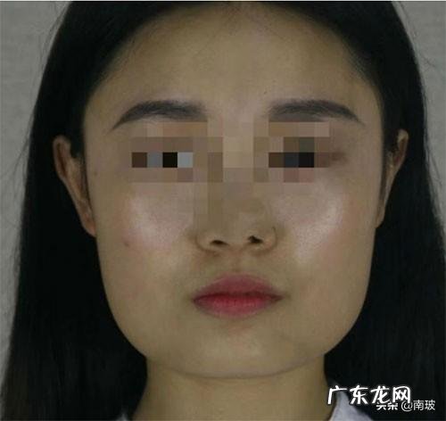 瘦脸需要多长时间?