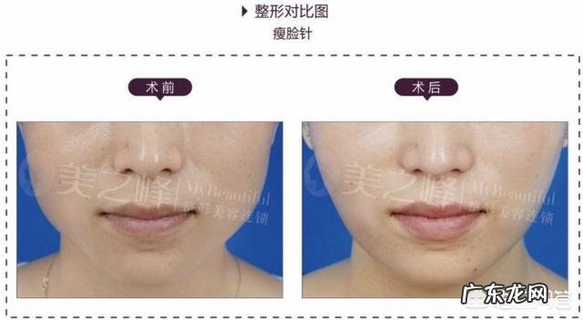 瘦脸针多久打一次?