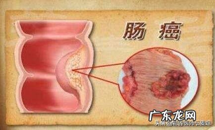 为什么说肠癌是幸运癌?