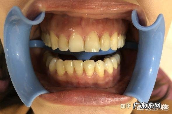 为什么很多人的牙齿很黄?