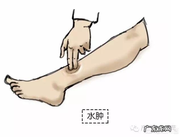 妊高症的罹患风险高是怎么回事?孕妇需要注意什么?