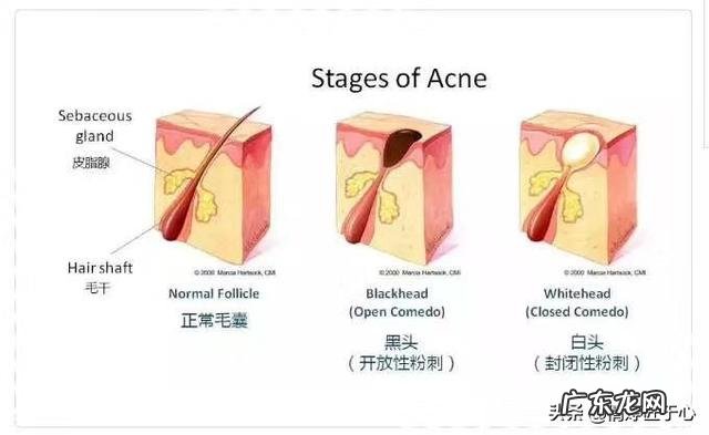 油性皮肤如何清洁毛孔,排出毛孔内垃圾,然后缩小毛孔?