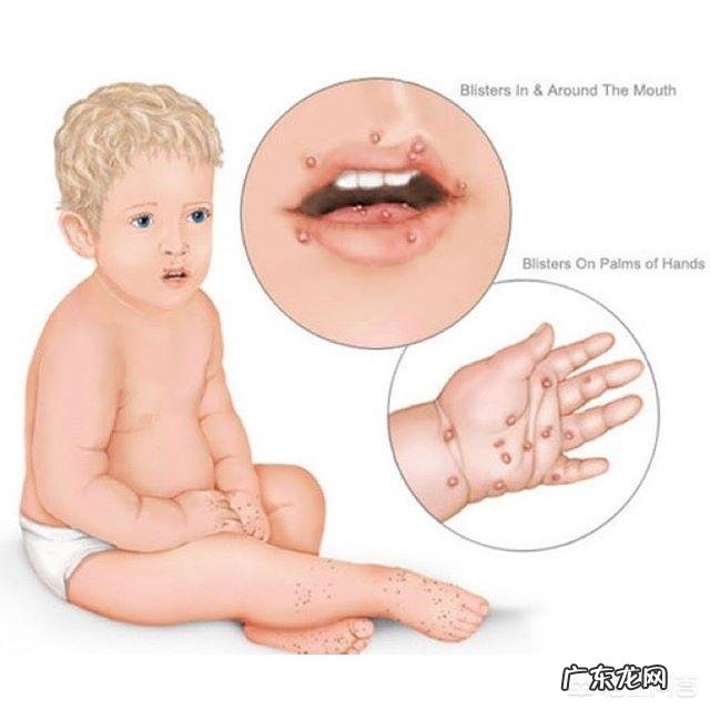 手足口病同期上升89.52%,如何科学预防儿童手足口病?