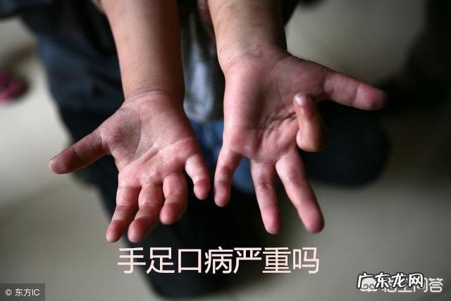 手足口病同期上升89.52%,如何科学预防儿童手足口病?